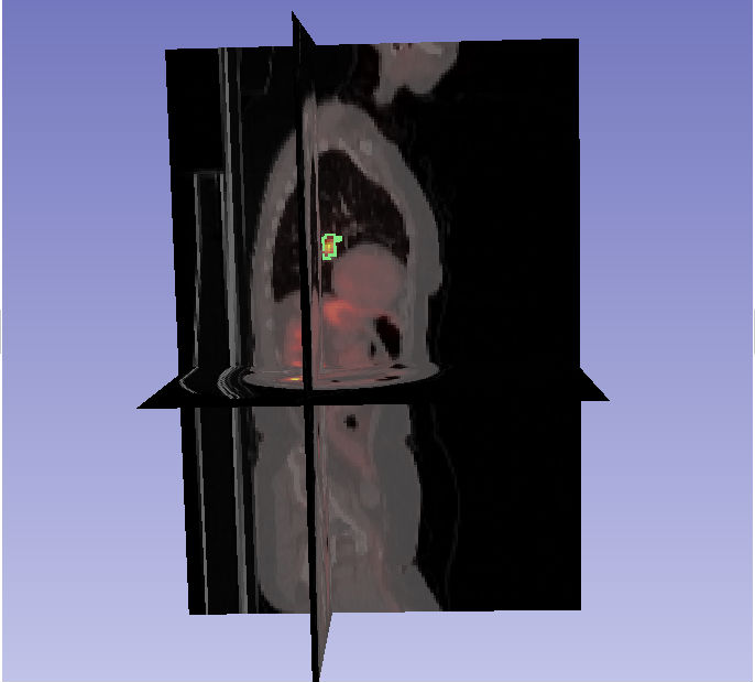 PETCT1.jpg