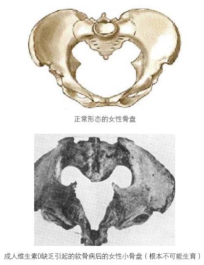 维生素D缺乏对孕产妇健康的影响