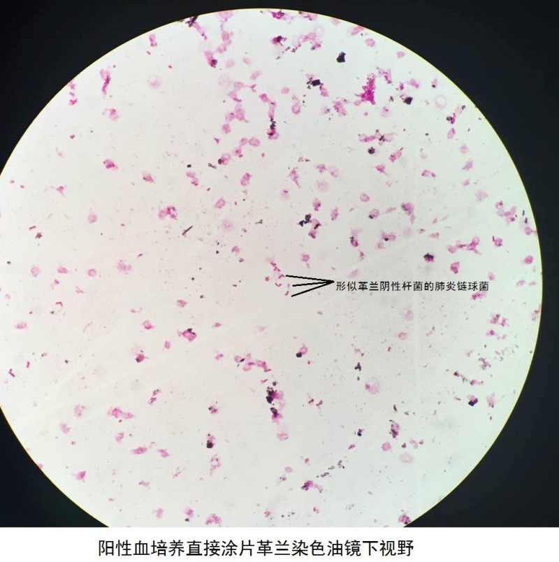 【检验临床面对面】“变脸高手”——阳性血培养中的肺炎链球菌 ...