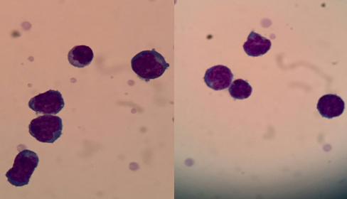 【检验临床面对面】淋巴瘤脑转移？脑脊液细胞学给答案