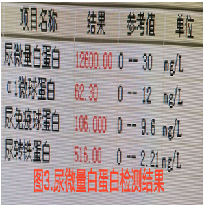 【检验临床面对面】“消失”的尿蛋白