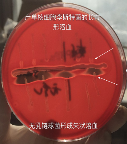 【检验临床面对面】初识产单核细胞李斯特菌